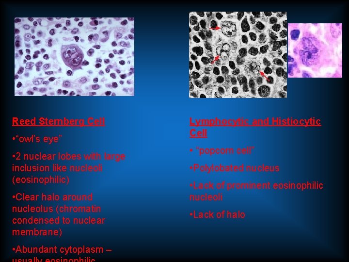 Reed Sternberg Cell • “owl’s eye” • 2 nuclear lobes with large inclusion like