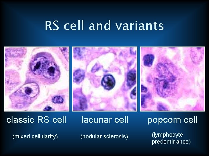 RS cell and variants classic RS cell lacunar cell popcorn cell (mixed cellularity) (nodular