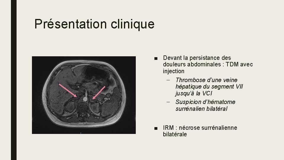 Présentation clinique ■ Devant la persistance des douleurs abdominales : TDM avec injection –