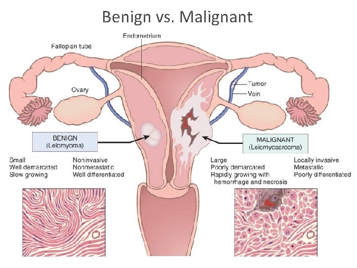 Benign vs. Malignant 