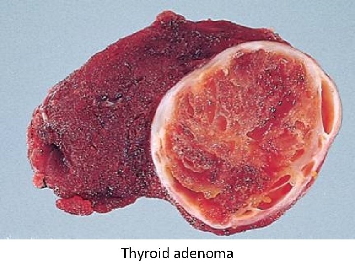 Thyroid adenoma 
