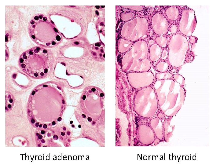 Thyroid adenoma Normal thyroid 