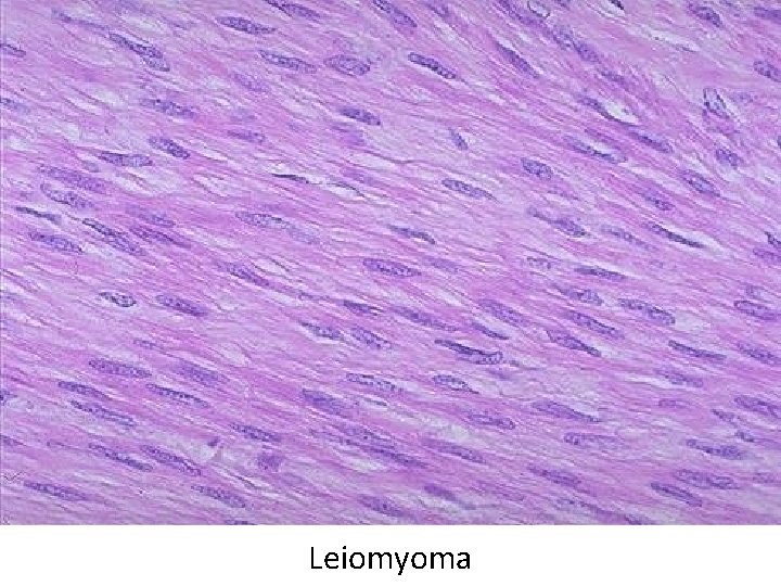 Leiomyoma 