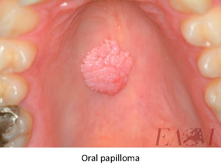 Oral papilloma 