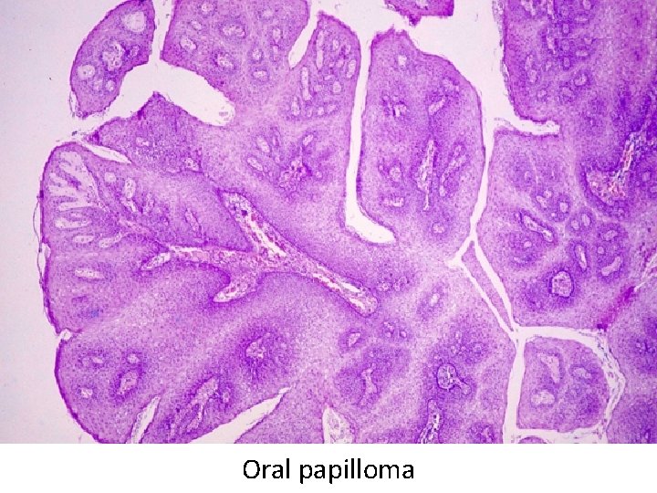 Oral papilloma 