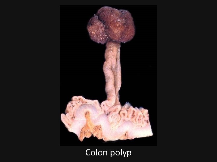 Colon polyp 