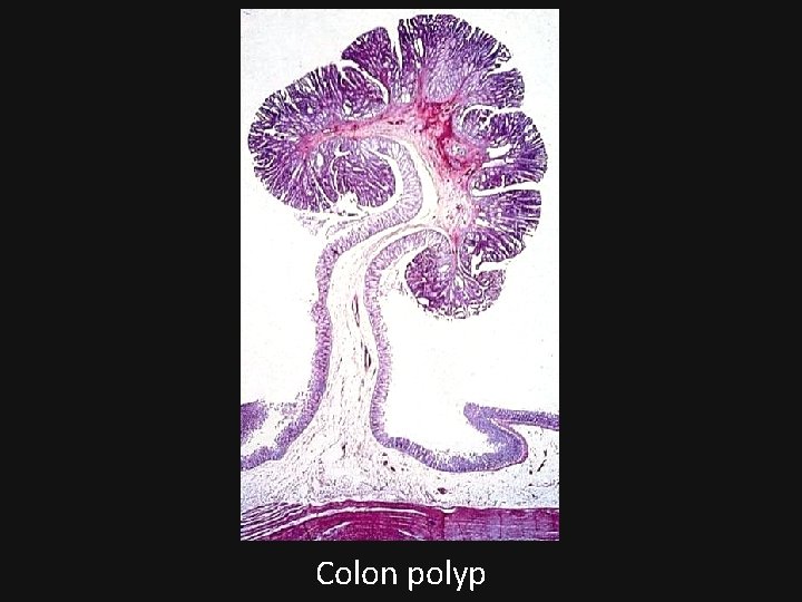 Colon polyp 