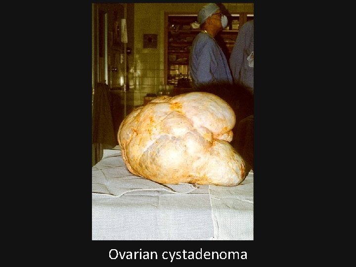 Ovarian cystadenoma 