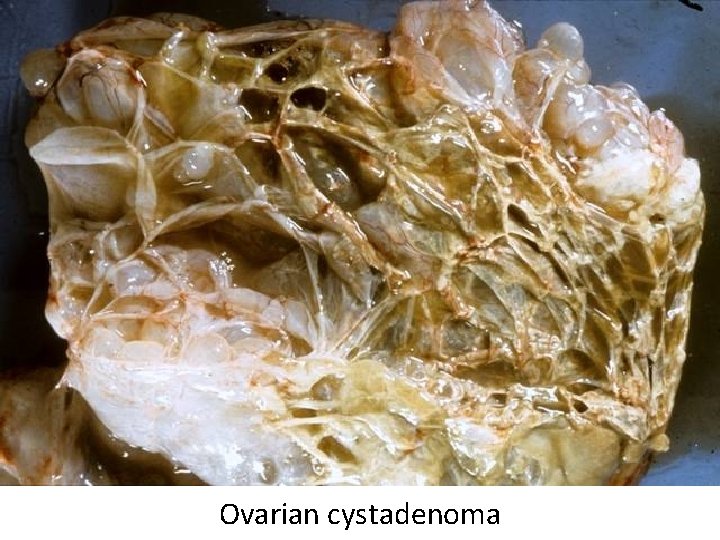 Ovarian cystadenoma 