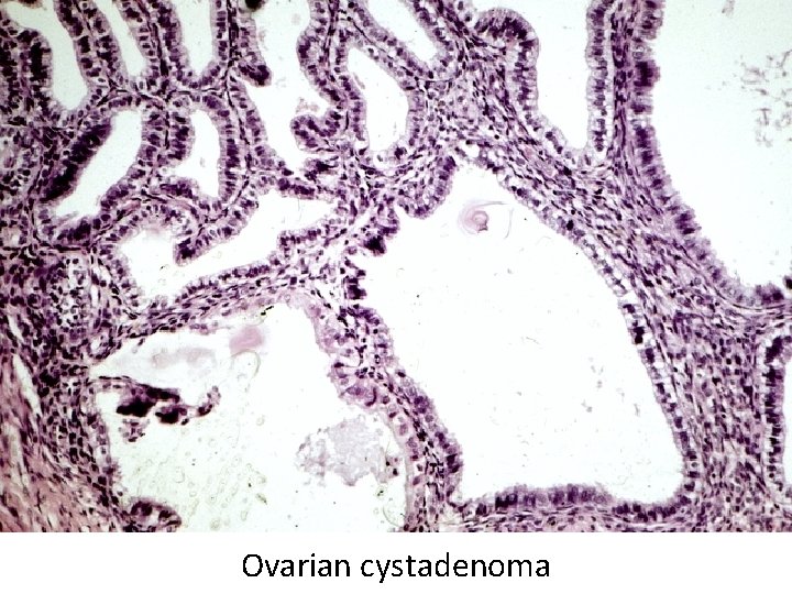 Ovarian cystadenoma 