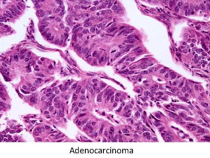 Adenocarcinoma 