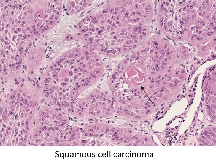 Squamous cell carcinoma 