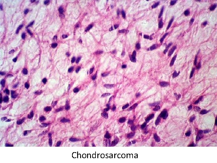 Chondrosarcoma 