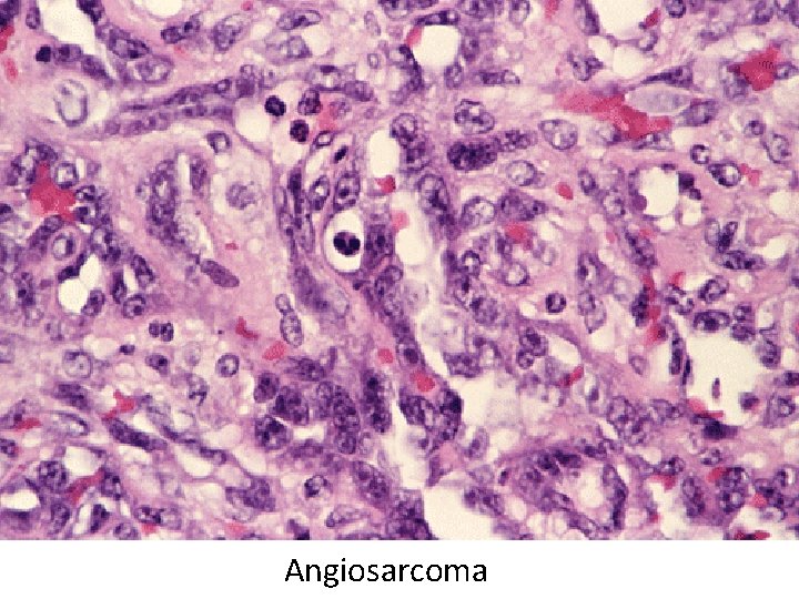 Angiosarcoma 