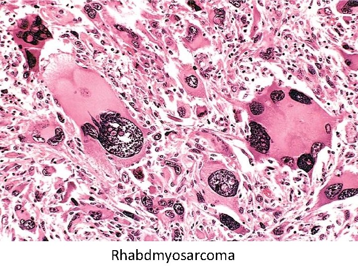 Rhabdmyosarcoma 