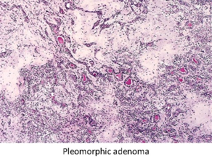 Pleomorphic adenoma 