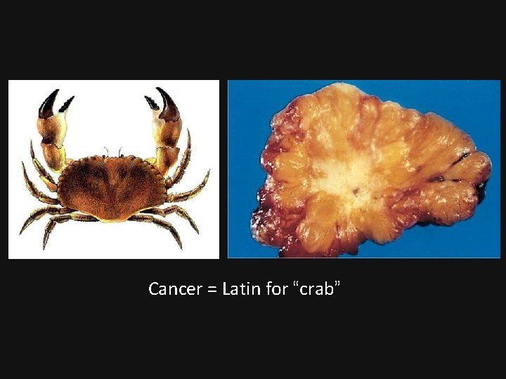 Cancer = Latin for “crab” 