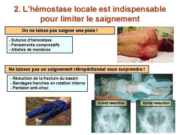 2. L’hémostase locale est indispensable pour limiter le saignement On ne laisse pas saigner