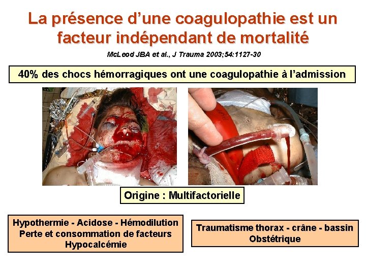 La présence d’une coagulopathie est un facteur indépendant de mortalité Mc. Leod JBA et