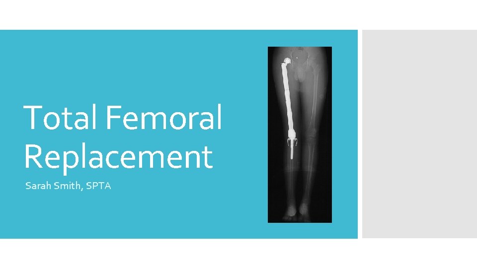 Total Femoral Replacement Sarah Smith, SPTA 
