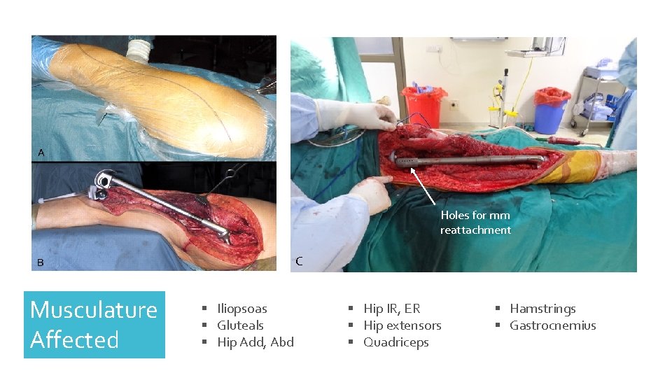Holes for mm reattachment C Musculature Affected § Iliopsoas § Gluteals § Hip Add,