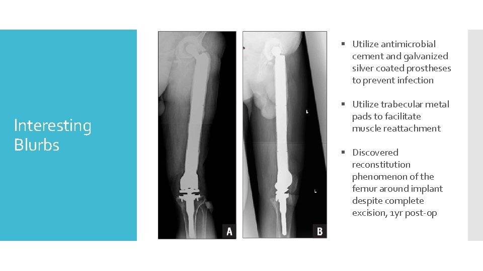 § Utilize antimicrobial cement and galvanized silver coated prostheses to prevent infection Interesting Blurbs