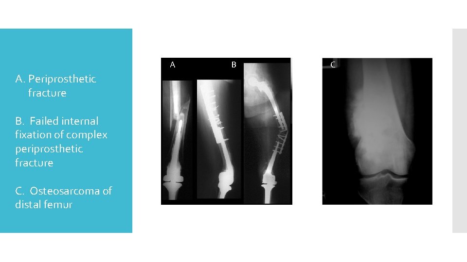 A. Periprosthetic fracture B. Failed internal fixation of complex periprosthetic fracture C. Osteosarcoma of