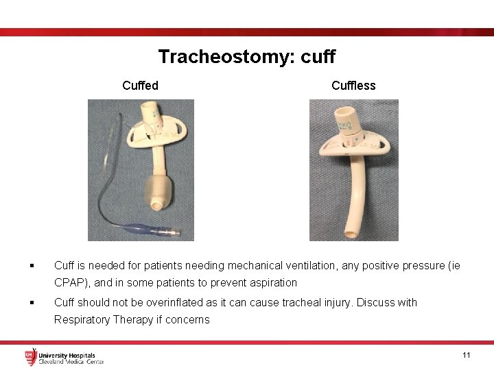 Tracheostomy: cuff Cuffed § Cuffless Cuff is needed for patients needing mechanical ventilation, any