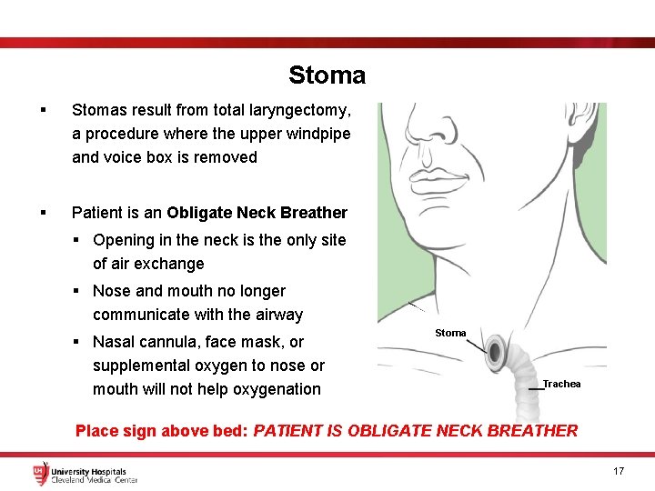 Stoma § Stomas result from total laryngectomy, a procedure where the upper windpipe and