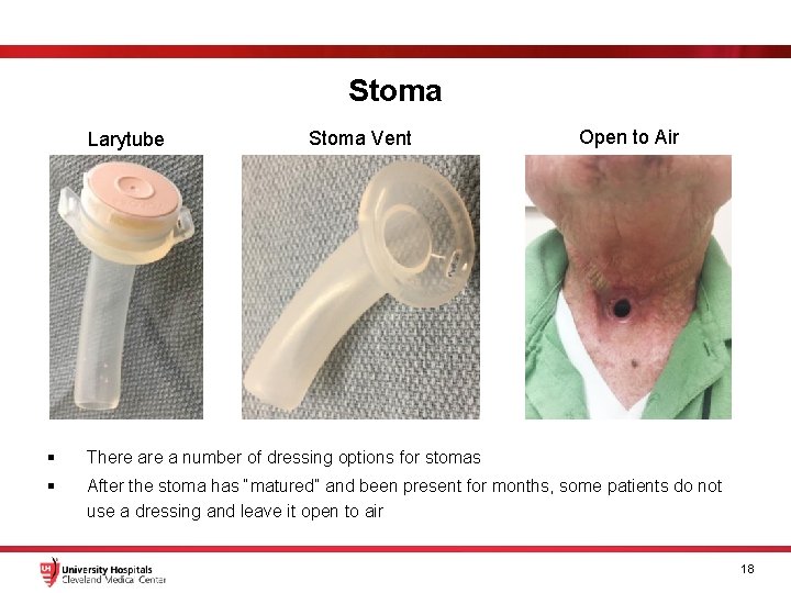 Stoma Larytube Stoma Vent Open to Air § There a number of dressing options