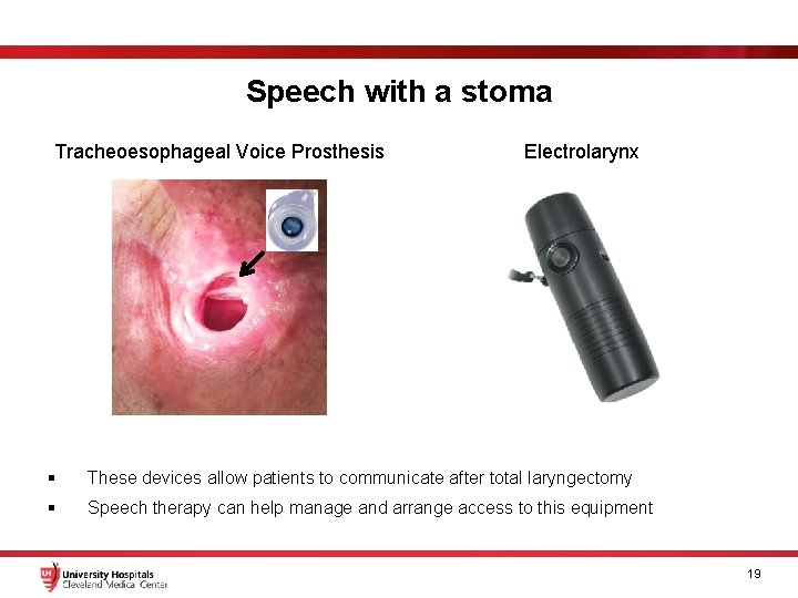 Speech with a stoma Tracheoesophageal Voice Prosthesis Electrolarynx § These devices allow patients to