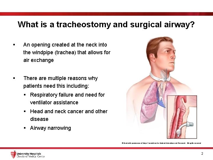 What is a tracheostomy and surgical airway? § An opening created at the neck