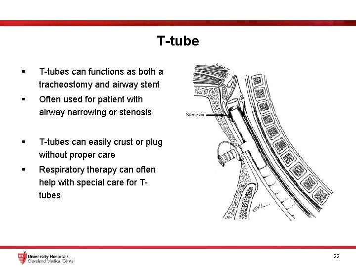 T-tube § T-tubes can functions as both a tracheostomy and airway stent § Often