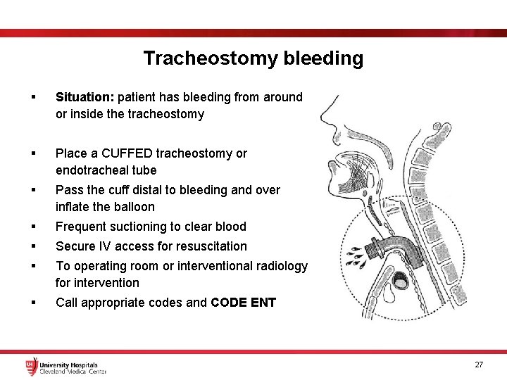 Tracheostomy bleeding § Situation: patient has bleeding from around or inside the tracheostomy §