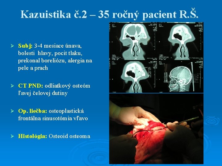 Kazuistika č. 2 – 35 ročný pacient R. Š. Subj: 3 -4 mesiace únava,