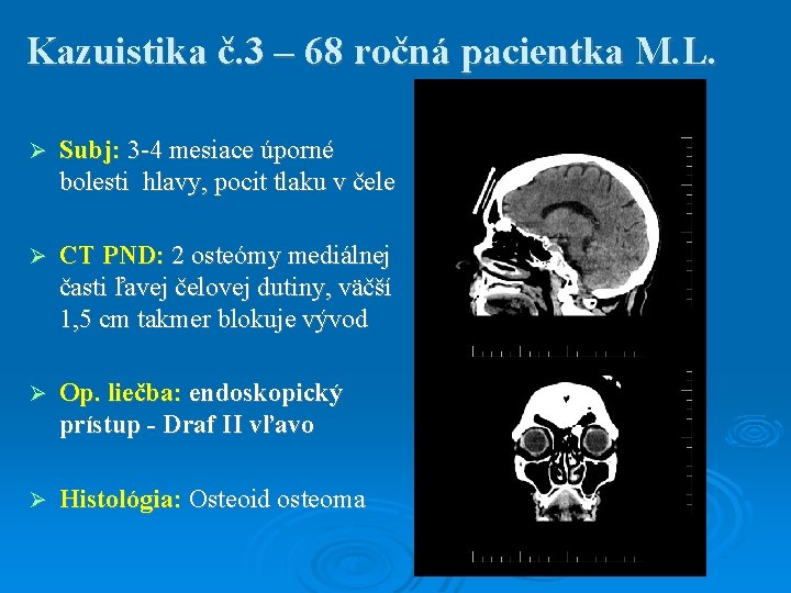 Kazuistika č. 3 – 68 ročná pacientka M. L. Subj: 3 -4 mesiace úporné