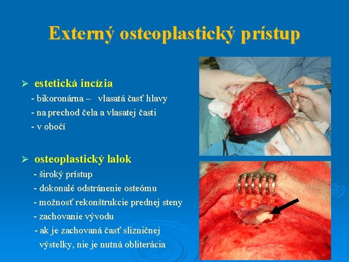 Externý osteoplastický prístup estetická incízia - bikoronárna – vlasatá časť hlavy - na prechod