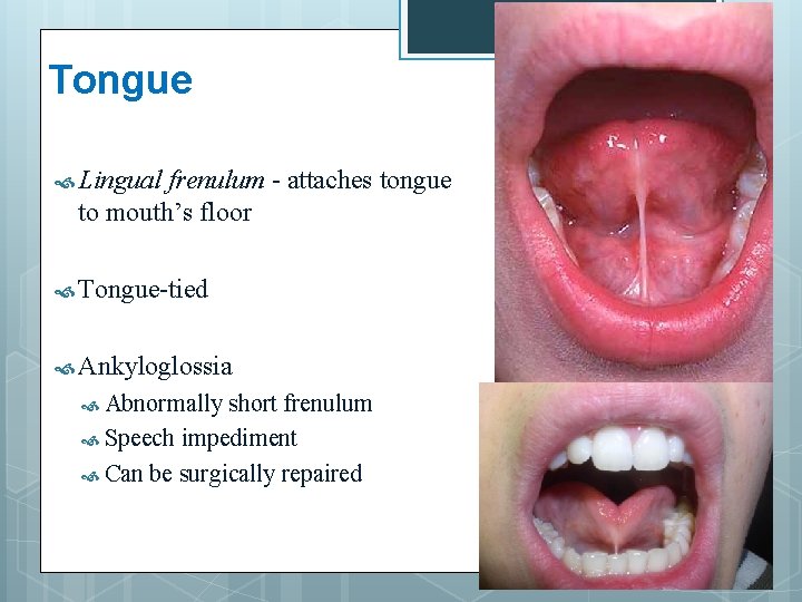 Tongue Lingual frenulum - attaches tongue to mouth’s floor Tongue-tied Ankyloglossia Abnormally short frenulum