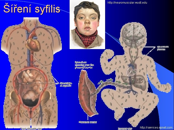 Šíření syfilis http: //neuromuscular. wustl. edu http: //services. epnet. com 