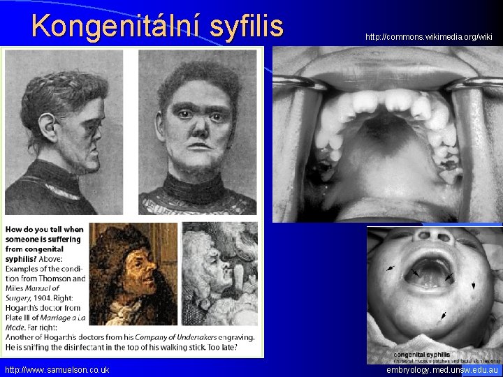 Kongenitální syfilis http: //www. samuelson. co. uk http: //commons. wikimedia. org/wiki embryology. med. unsw.
