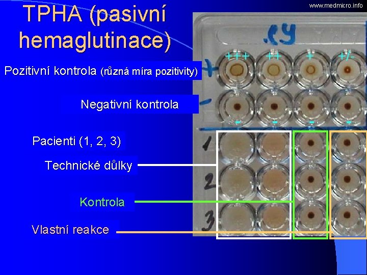 TPHA (pasivní hemaglutinace) Pozitivní kontrola (různá míra pozitivity) www. medmicro. info +++ ++ +