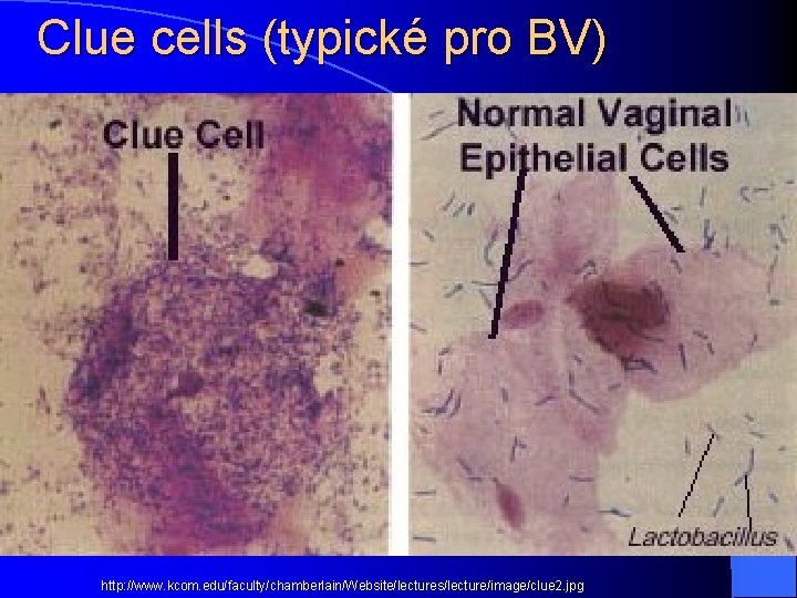 Clue cells (typické pro BV) http: //www. kcom. edu/faculty/chamberlain/Website/lectures/lecture/image/clue 2. jpg 