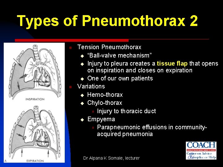 Types of Pneumothorax 2 n n Tension Pneumothorax u “Ball-valve mechanism” u Injury to