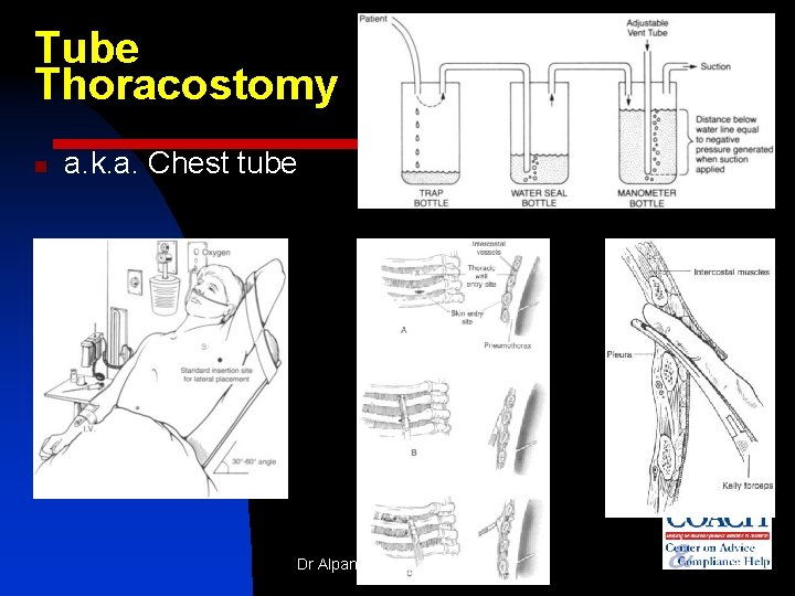Tube Thoracostomy n a. k. a. Chest tube Dr Alpana K Somale, lecturer 34