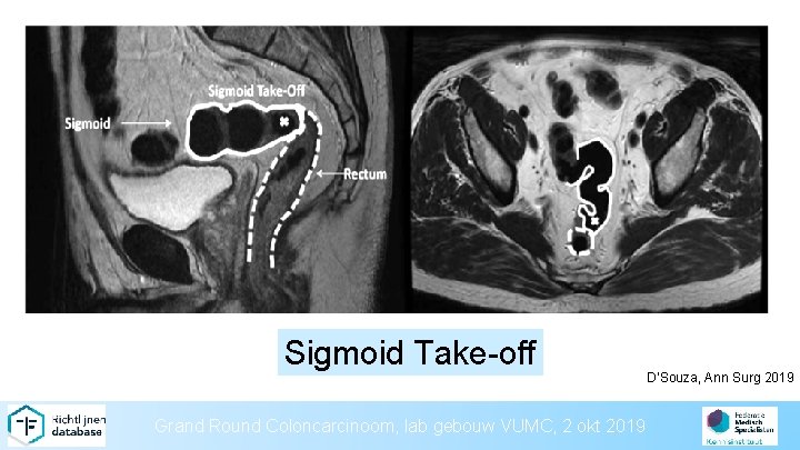 Sigmoid Take-off Grand Round Coloncarcinoom, lab gebouw VUMC, 2 okt 2019 D’Souza, Ann Surg