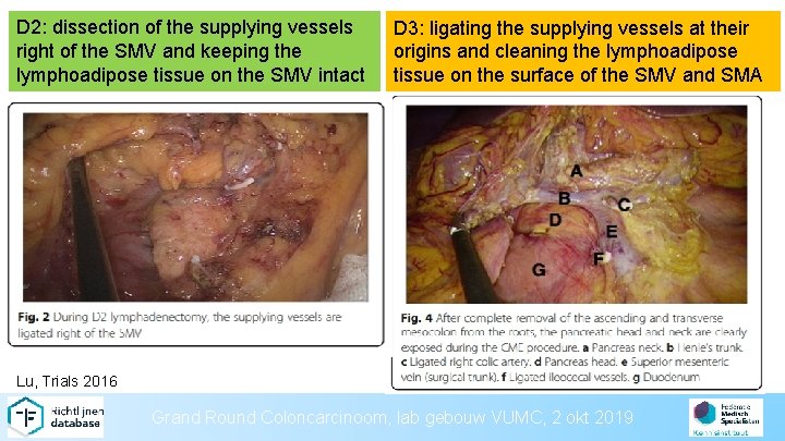 D 2: dissection of the supplying vessels right of the SMV and keeping the