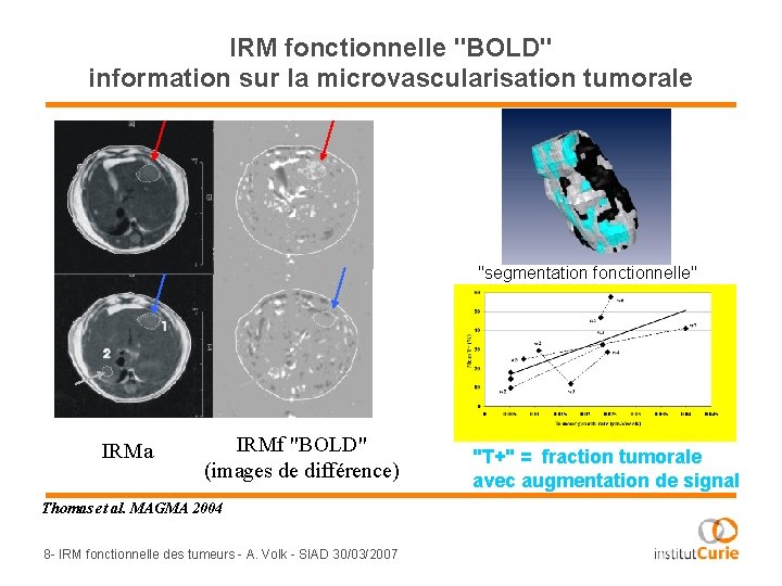 IRM fonctionnelle "BOLD" information sur la microvascularisation tumorale "segmentation fonctionnelle" IRMa IRMf "BOLD" (images