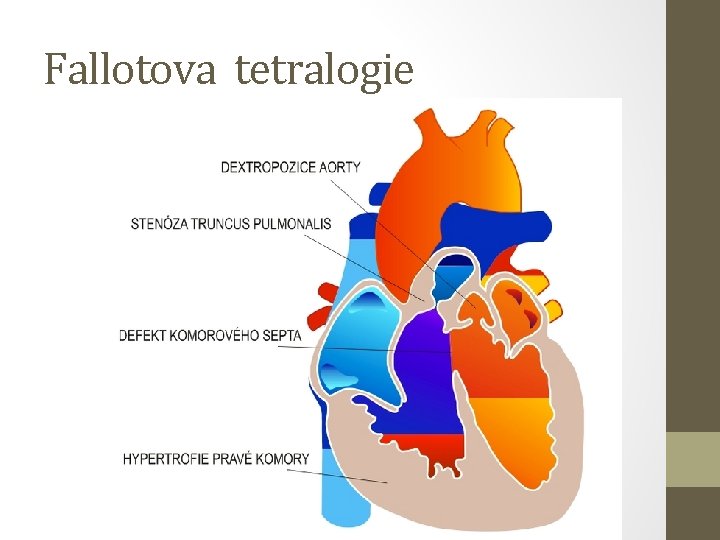 Fallotova tetralogie 