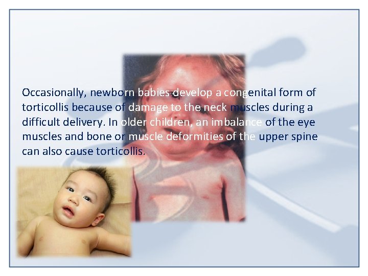 Occasionally, newborn babies develop a congenital form of torticollis because of damage to the