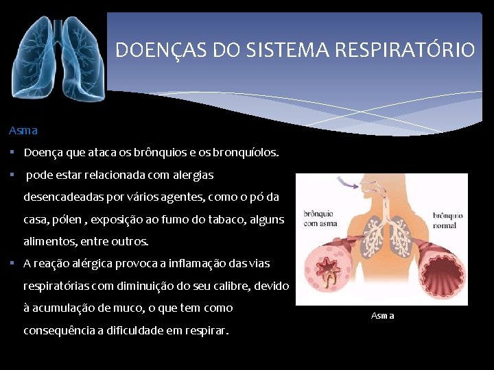 DOENÇAS DO SISTEMA RESPIRATÓRIO Asma § Doença que ataca os brônquios e os bronquíolos.